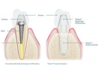 Hansgrohe-Gründerfamilie investiert in innovative Zahnimplantat-Technologie von Zircon Medical