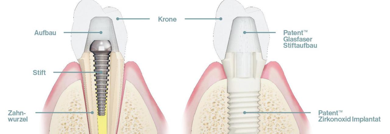 Hansgrohe-Gründerfamilie investiert in innovative Zahnimplantat-Technologie von Zircon Medical